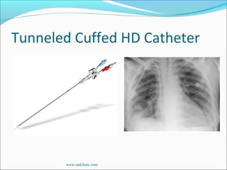 Tunneled Cuffed HD Catheter
www.radclinic.com
 