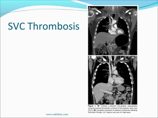 SVC Thrombosis
www.radclinic.com
 