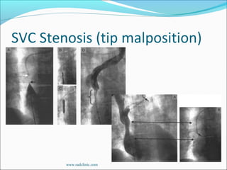 SVC Stenosis (tip malposition)
www.radclinic.com
 