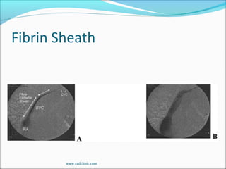 Fibrin Sheath
www.radclinic.com
 