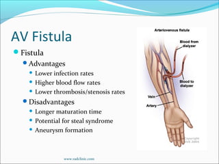 AV Fistula
Fistula
Advantages
 Lower infection rates
 Higher blood flow rates
 Lower thrombosis/stenosis rates
Disadvantages
 Longer maturation time
 Potential for steal syndrome
 Aneurysm formation
www.radclinic.com
 