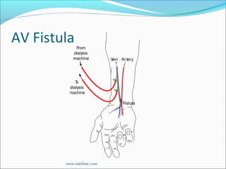 AV Fistula
www.radclinic.com
 
