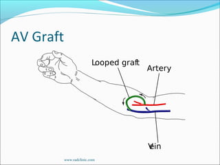 AV Graft
www.radclinic.com
 