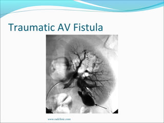 Traumatic AV Fistula
www.radclinic.com
 