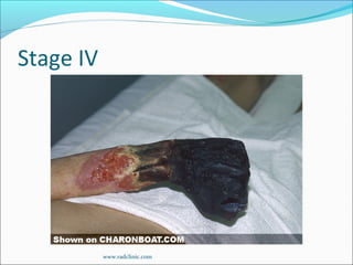 Stage IV
www.radclinic.com
 