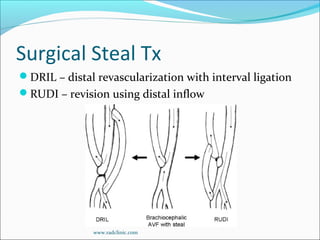 Surgical Steal Tx
DRIL – distal revascularization with interval ligation
RUDI – revision using distal inflow
www.radclinic.com
 