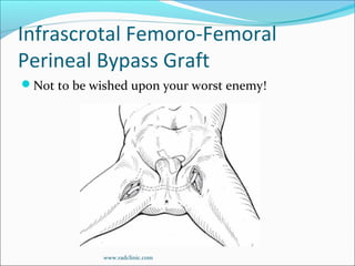 Infrascrotal Femoro-Femoral
Perineal Bypass Graft
Not to be wished upon your worst enemy!
www.radclinic.com
 