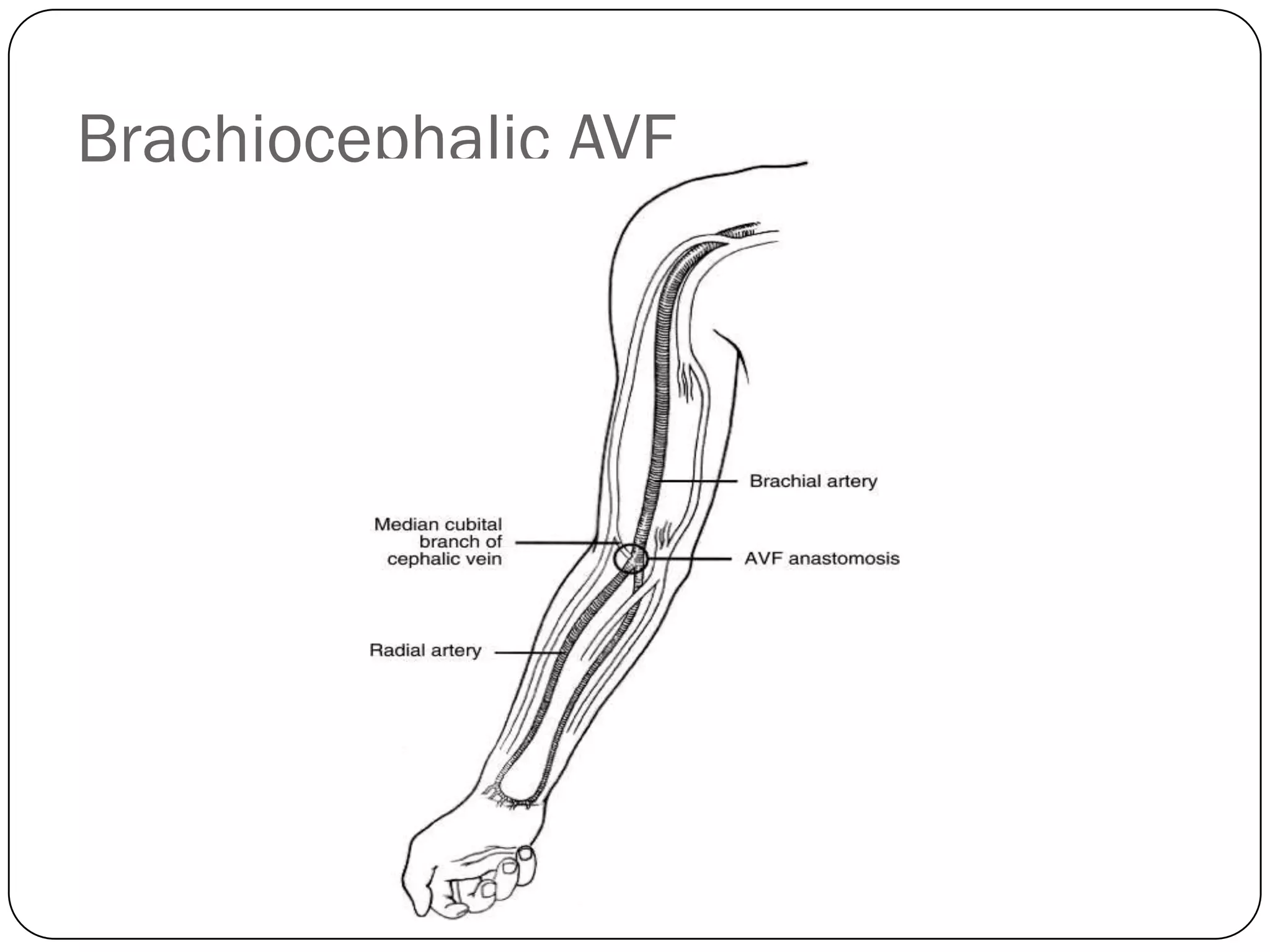Brachiocephalic AVF
 