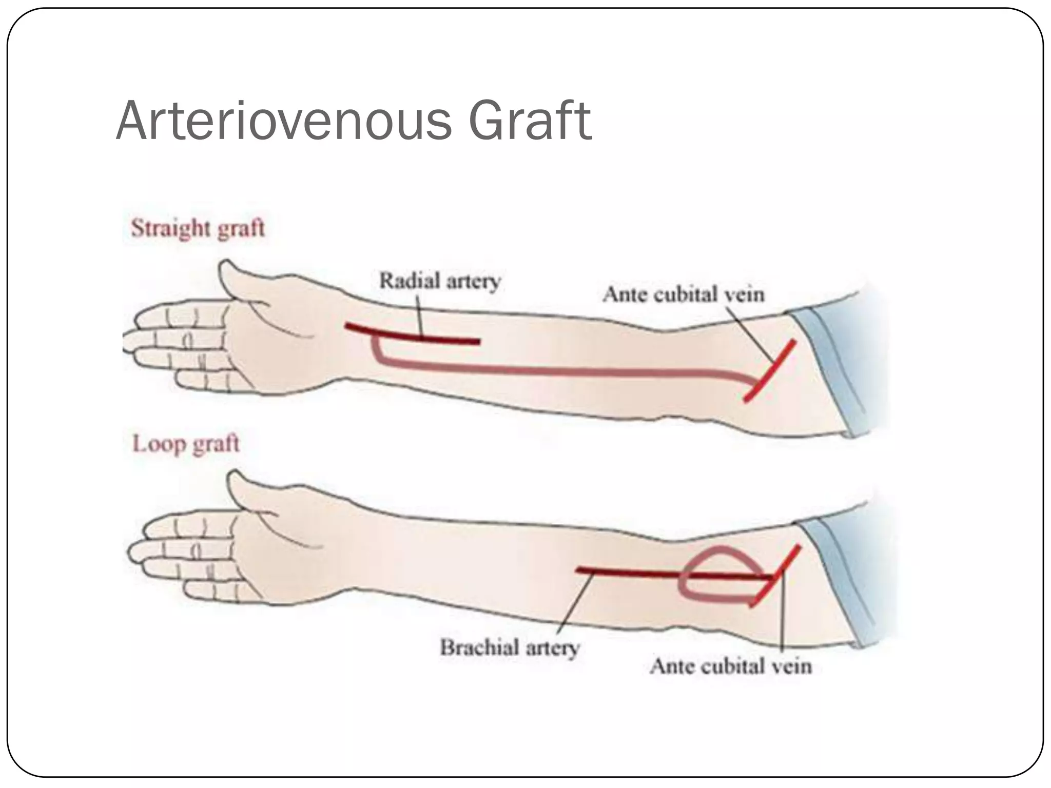 Arteriovenous Graft
 