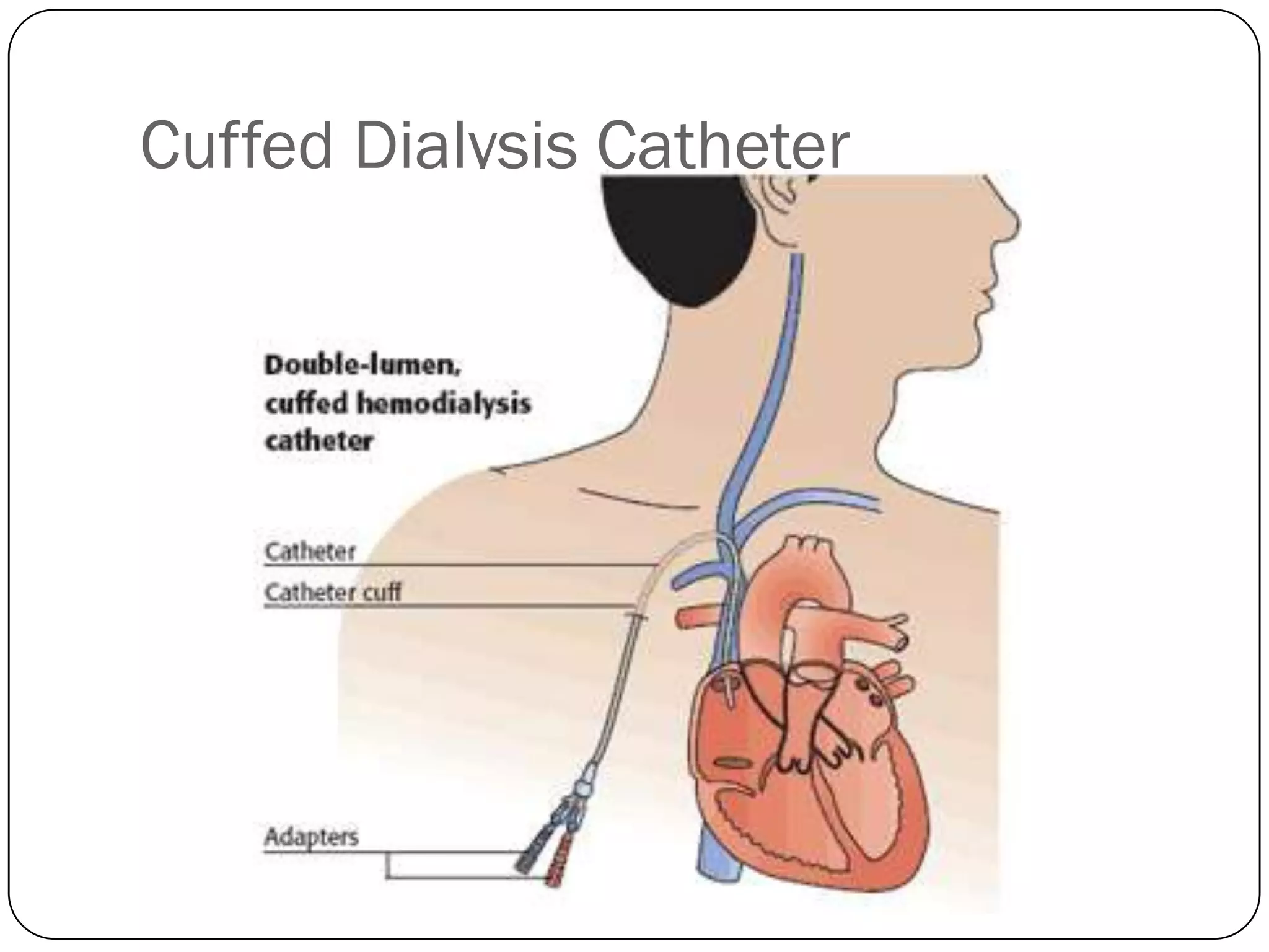 Cuffed Dialysis Catheter
 