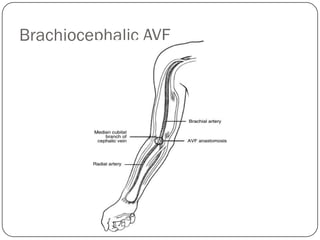 Brachiocephalic AVF
 