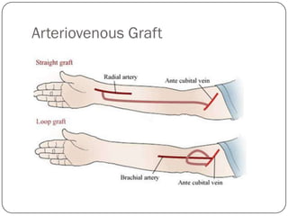 Arteriovenous Graft
 