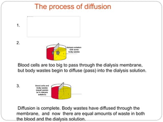 The process of diffusion
1.
2.
Blood cells are too big to pass through the dialysis membrane,
but body wastes begin to diffuse (pass) into the dialysis solution.
3.
Diffusion is complete. Body wastes have diffused through the
membrane, and now there are equal amounts of waste in both
the blood and the dialysis solution.
 