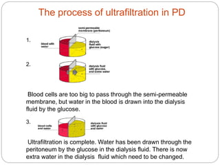 The process of ultrafiltration in PD
1.
2.
Blood cells are too big to pass through the semi-permeable
membrane, but water in the blood is drawn into the dialysis
fluid by the glucose.
3.
Ultrafiltration is complete. Water has been drawn through the
peritoneum by the glucose in the dialysis fluid. There is now
extra water in the dialysis fluid which need to be changed.
 
