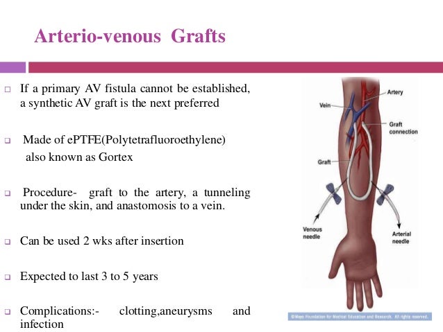 Arteriovenous Shunt For Renal Dialysis Diet