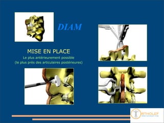 DIAM

        MISE EN PLACE
      Le plus antérieurement possible
(le plus près des articulaires postérieures)
 