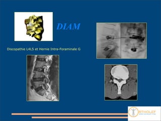 DIAM

Discopathie L4L5 et Hernie Intra-Foraminale G
 