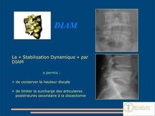 DIAM


La « Stabilisation Dynamique » par
DIAM

                 a permis :

 de conserver la hauteur discale

 de limiter la surcharge des articulaires
  postérieures secondaire à la discectomie
 
