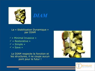 DIAM

    La « Stabilisation Dynamique »
               par DIAM

« Minimal Invasive »
 « Restorative »
 « Simple »
 « Save »

 Le DIAM respecte la fonction et
les structures, il ne coupe aucun
       pont pour le futur !
 