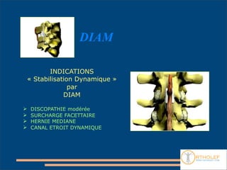 DIAM

           INDICATIONS
    « Stabilisation Dynamique »
                  par
                DIAM

    DISCOPATHIE modérée
    SURCHARGE FACETTAIRE
    HERNIE MEDIANE
    CANAL ETROIT DYNAMIQUE
 