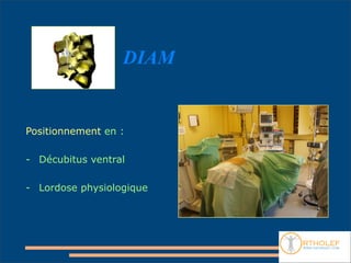 DIAM


Positionnement en :

- Décubitus ventral

- Lordose physiologique
 
