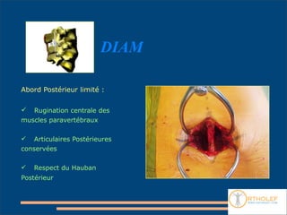 DIAM

Abord Postérieur limité :

  Rugination centrale des
muscles paravertébraux

   Articulaires Postérieures
conservées

   Respect du Hauban
Postérieur
 