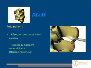DIAM

Préparation :


-    Résection des tissus inter-
    épineux


-    Respect du ligament
    supra-épineux
    (Hauban Postérieur)
 