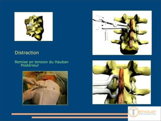 Distraction

Remise en tension du Hauban
  Postérieur
 