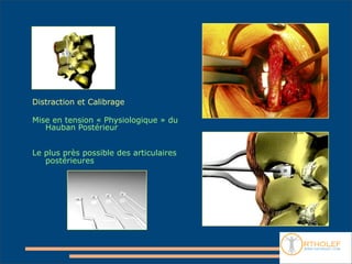 Distraction et Calibrage

Mise en tension « Physiologique » du
   Hauban Postérieur


Le plus près possible des articulaires
   postérieures
 