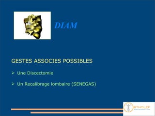 DIAM



GESTES ASSOCIES POSSIBLES

 Une Discectomie

 Un Recalibrage lombaire (SENEGAS)
 
