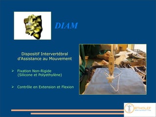 DIAM


     Dispositif Intervertébral
   d’Assistance au Mouvement


 Fixation Non-Rigide
  (Silicone et Polyethylène)


 Contrôle en Extension et Flexion
 