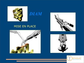 DIAM

MISE EN PLACE
 