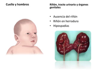 Cuello y hombros Riñón, tracto urinario y órganos 
genitales 
• Ausencia del riñón 
• Riñón en herradura 
• Hipospadias 
 