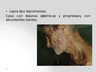 y progresivas, con
• Lepra tipo lepromatoso
Caso con lesiones sistémicas
abundantes bacilos.
 