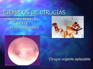 EJEMPLOS DE CIRUGÍAS Cirugía urgente: accidente automovilístico Cirugía urgente aplazable 