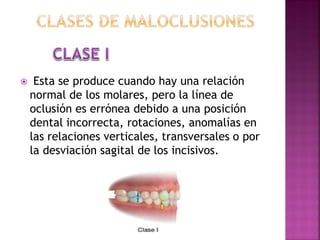  Esta se produce cuando hay una relación
normal de los molares, pero la línea de
oclusión es errónea debido a una posición
dental incorrecta, rotaciones, anomalías en
las relaciones verticales, transversales o por
la desviación sagital de los incisivos.
 
