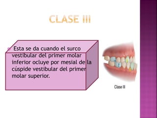  Esta se da cuando el surco
vestibular del primer molar
inferior ocluye por mesial de la
cúspide vestibular del primer
molar superior.
 