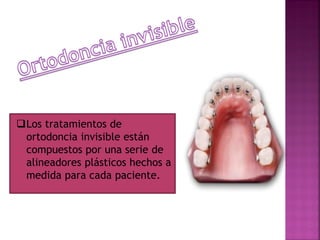 Los tratamientos de
ortodoncia invisible están
compuestos por una serie de
alineadores plásticos hechos a
medida para cada paciente.
 