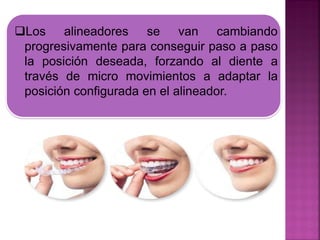 Los alineadores se van cambiando
progresivamente para conseguir paso a paso
la posición deseada, forzando al diente a
través de micro movimientos a adaptar la
posición configurada en el alineador.
 
