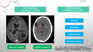 DIAGNOSTICO
DIFERENCIAL
EQUINOCOCOSIS
CEREBRAL
Absceso cerebral Quiste aracnoideo
DIAGNOSTICO
DIFERENCIAL
EQUINOCOCOSIS
ALVEOLAR
Gliomas
Metastasis
Tuberculomas
Metástasis fungicas
Izci Y, Tüzün Y, Seçer HI, Gönül E. Cerebral hydatid cysts:
technique and pitfalls of surgical management. Neurosurg Focus.
2008;24(6):E15. doi: 10.3171/FOC/2008/24/6/E15. PMID: 18518745.
 