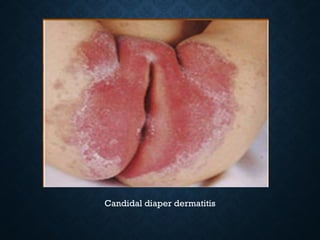 DIAPER RASH and its presentation and its treatment.pptx