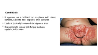 Diaper rash in pediatrics in small neonates | PDF