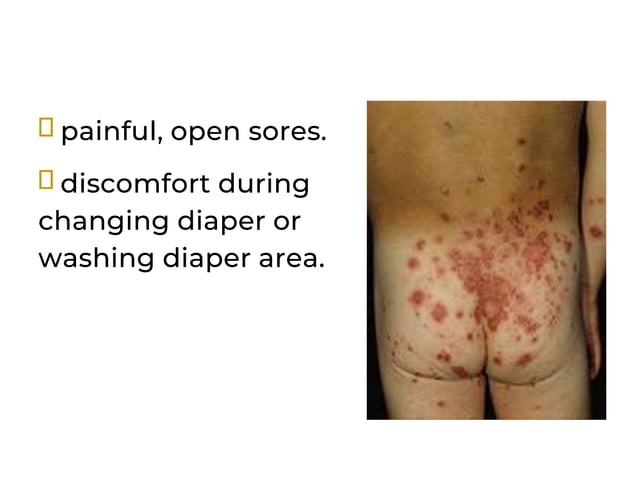 diaper rashes causes and treatment and prevention | PPTX | Parenting ...