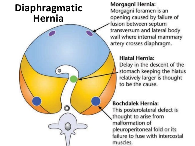 Diaphragmatic Hernia And Injury
