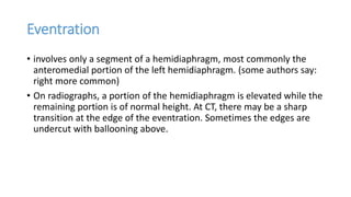 Eventrated Imaging of diaphragm and its pathologies by Dr. Milan | PPTX