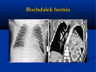 BochdalekBochdalek herniahernia
 