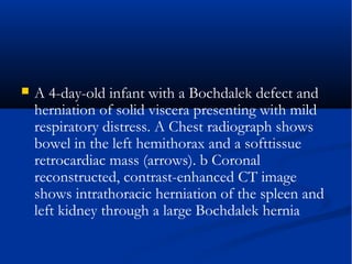  A 4-day-old infant with a Bochdalek defect and
herniation of solid viscera presenting with mild
respiratory distress. A Chest radiograph shows
bowel in the left hemithorax and a softtissue
retrocardiac mass (arrows). b Coronal
reconstructed, contrast-enhanced CT image
shows intrathoracic herniation of the spleen and
left kidney through a large Bochdalek hernia
 