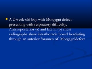  A 2-week-old boy with Morgagni defect
presenting with respiratory difficulty.
Anteroposterior (a) and lateral (b) chest
radiographs show intrathoracic bowel herniating
through an anterior foramen of Morgagnidefect
 