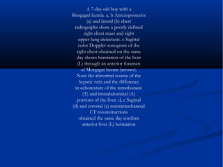 A 7-day-old boy with a
Morgagni hernia. a, b Anteroposterior
(a) and lateral (b) chest
radiographs show a poorly defined
right chest mass and right
upper lung atelectasis. c Sagittal
color Doppler sonogram of the
right chest obtained on the same
day shows herniation of the liver
(L) through an anterior foramen
of Morgagni hernia (arrows).
Note the abnormal course of the
hepatic vein and the difference
in echotexture of the intrathoracic
(T) and intraabdominal (A)
portions of the liver. d, e Sagittal
(d) and coronal (e) contrastenhanced
CT reconstructions
obtained the same day confirm
anterior liver (L) herniation
 