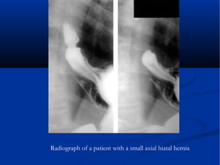Radiograph of a patient with a small axial hiatal hernia
 